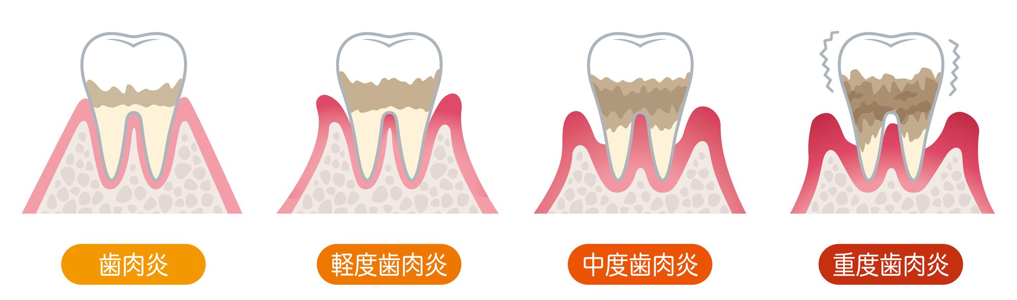 歯周病の進行｜白河のジュンデンタルクリニック